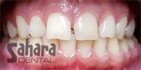 Dental Crowns Case-9