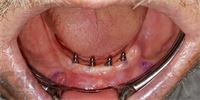 Mini Dental Implants Case-1