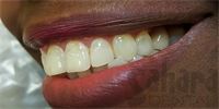 Dental Implant Case-4