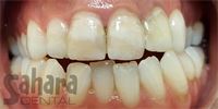 Dental Crowns Case-4