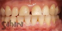 Dental Crowns Case-6