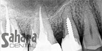  Dental Root Canal-2
